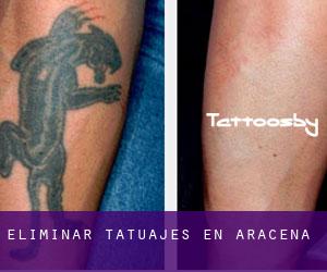 Eliminar tatuajes en Aracena