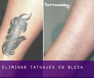 Eliminar tatuajes en Blesa