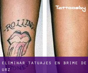 Eliminar tatuajes en Brime de Urz