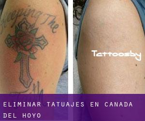 Eliminar tatuajes en Cañada del Hoyo