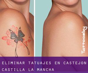 Eliminar tatuajes en Castejón (Castilla-La Mancha)