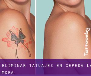 Eliminar tatuajes en Cepeda la Mora