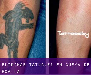 Eliminar tatuajes en Cueva de Roa (La)