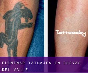 Eliminar tatuajes en Cuevas del Valle