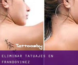 Eliminar tatuajes en Frandovínez