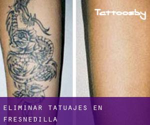 Eliminar tatuajes en Fresnedilla