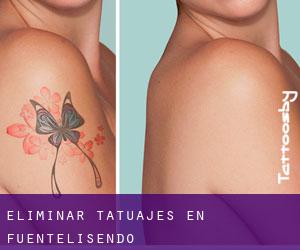 Eliminar tatuajes en Fuentelisendo