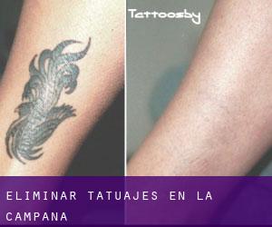 Eliminar tatuajes en La Campana