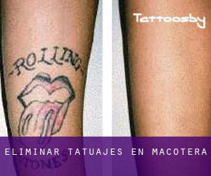 Eliminar tatuajes en Macotera