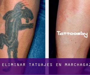 Eliminar tatuajes en Marchagaz