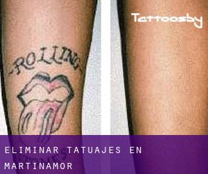 Eliminar tatuajes en Martinamor