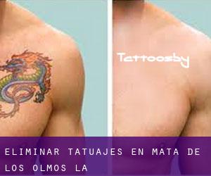 Eliminar tatuajes en Mata de los Olmos (La)