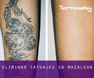 Eliminar tatuajes en Mazaleón