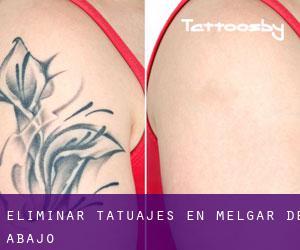 Eliminar tatuajes en Melgar de Abajo