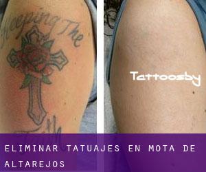 Eliminar tatuajes en Mota de Altarejos