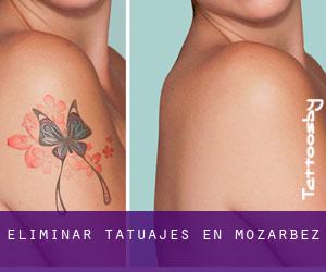 Eliminar tatuajes en Mozárbez