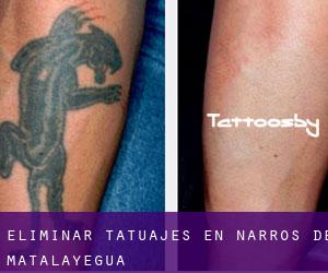 Eliminar tatuajes en Narros de Matalayegua