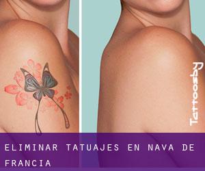 Eliminar tatuajes en Nava de Francia