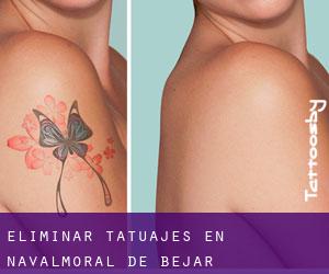 Eliminar tatuajes en Navalmoral de Béjar