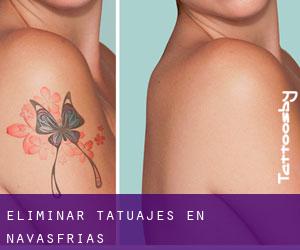 Eliminar tatuajes en Navasfrías