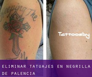 Eliminar tatuajes en Negrilla de Palencia