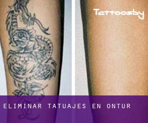 Eliminar tatuajes en Ontur