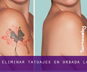 Eliminar tatuajes en Orbada (La)