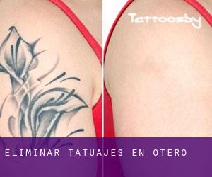 Eliminar tatuajes en Otero