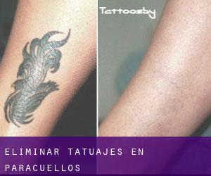 Eliminar tatuajes en Paracuellos