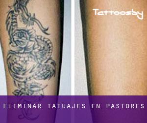 Eliminar tatuajes en Pastores