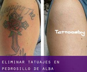 Eliminar tatuajes en Pedrosillo de Alba