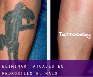 Eliminar tatuajes en Pedrosillo el Ralo