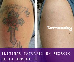 Eliminar tatuajes en Pedroso de la Armuña (El)