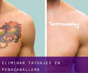 Eliminar tatuajes en Peñacaballera