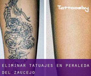 Eliminar tatuajes en Peraleda del Zaucejo