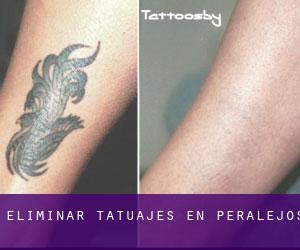 Eliminar tatuajes en Peralejos