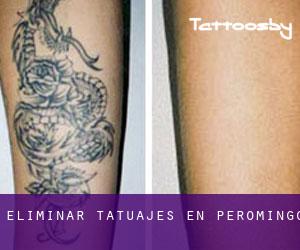 Eliminar tatuajes en Peromingo