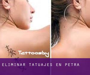 Eliminar tatuajes en Petra