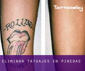 Eliminar tatuajes en Pinedas