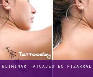 Eliminar tatuajes en Pizarral