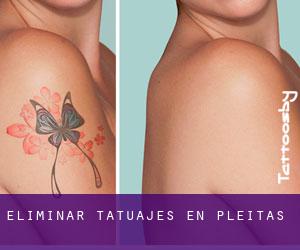 Eliminar tatuajes en Pleitas