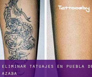 Eliminar tatuajes en Puebla de Azaba