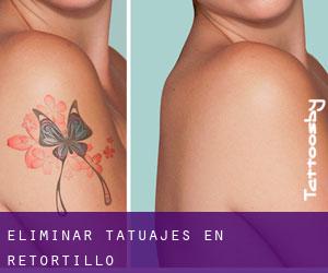 Eliminar tatuajes en Retortillo