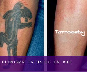 Eliminar tatuajes en Rus