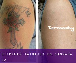 Eliminar tatuajes en Sagrada (La)