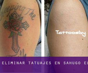 Eliminar tatuajes en Sahugo (El)