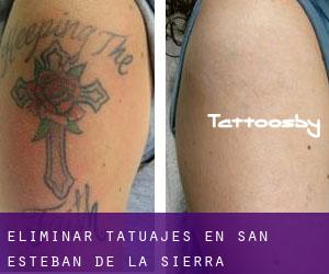 Eliminar tatuajes en San Esteban de la Sierra