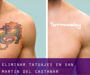 Eliminar tatuajes en San Martín del Castañar