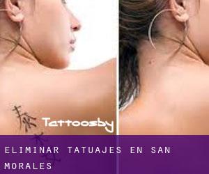 Eliminar tatuajes en San Morales