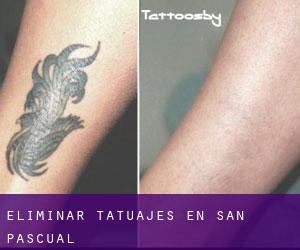 Eliminar tatuajes en San Pascual